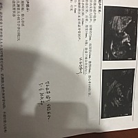 顺利通过nt检查，下一步就是唐氏筛查啦 啦啦啦啦