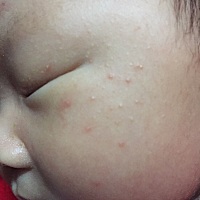 请问宝宝脸上这个是什么呀？两边都有，要涂什么吗？