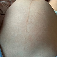 肚子上涨白斑谁知道这是咋了… 前两天肚皮痒然后起了很多红疙瘩 下去了之后就这样了…这还不是妊娠纹…