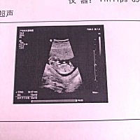 大家能不能帮忙看看nt单 是男宝宝女宝宝 谢谢 比较好奇