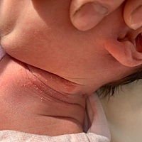 宝宝脖子中间泛红脱皮 有几块很红 像快烂进去一样  该怎么办