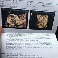 宝宝很乖.NT第一次过。希望各位宝妈顺利第一次过。也希望接下去的检查顺顺利利。😄