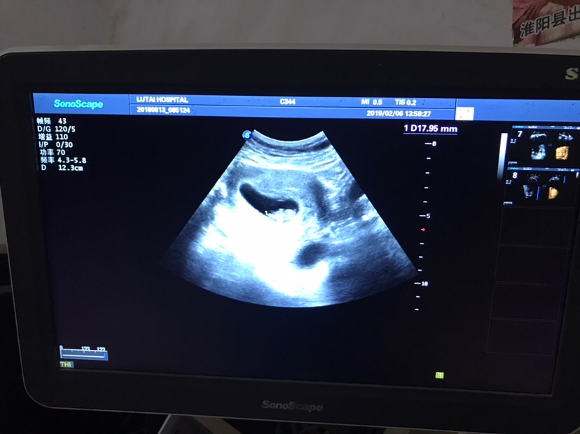 两个月的B超图片，有没有懂得人帮忙看下呢，二胎了