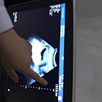 看胎芽的长短真的可以分辨男女吗，我们这边老人都说胎芽长长的像茄子一样就是男孩，圆圆的胎芽就是女孩...