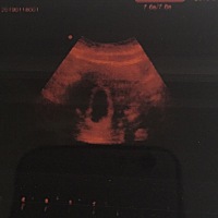 这种孕囊形状是男宝女宝求助？