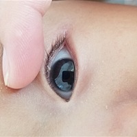 宝宝上眼皮起了个小米粒一样的东西，有知道是怎么回事的宝妈吗？怎么样快速下去