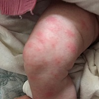 谁知道我家宝宝腿上涨的什么啊，