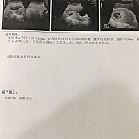 有两次颅内静脉窦血栓史，妊娠糖尿病史，妊期血小板减少史，很纠结要不要这个孩子，而且已经38岁了