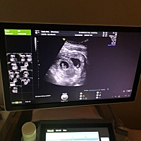 孕九周双胎，无孕吐反应，体重增加了14斤，胖成球了，有没有差不多的宝妈，进来聊聊，你们都是怎样控制...