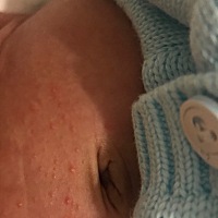 这是湿疹吗？前几天脸上长了些自动消了。这两天宝宝头上跟身上都长了。