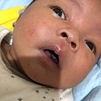 各位宝妈，请问宝宝脸上长的这些是什么，痘痘吗？越来越多，昨天都没这么多呢