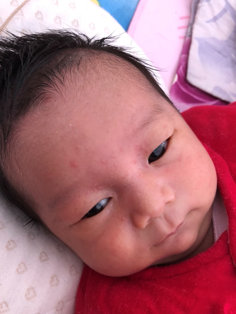 宝宝20天脸上出现这种红色小疹子，别的宝妈们知不知道这是怎么了，是热了么，心疼