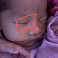 宝宝眼皮上有红血丝，不会是血管瘤吧？