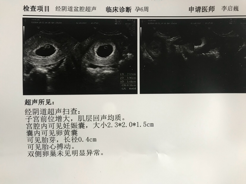 B超孕囊数值看男女