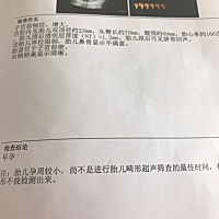 13周NT宝宝不配合 溜达一个小时还是不行，为娘很愁，还好都正常