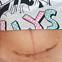 剖腹产疤痕 我的二胎子宫疤痕，小棉袄本应是今天预产期，提前10天出来凑热闹。伤口已经好得差不多了基本...