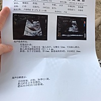 宝宝很棒，NT一次过，早唐结果还要一周才有，愿好孕。