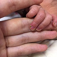 宝宝15天，指甲长倒刺变成这样了，请问一下各位宝妈这是什么情况，需要去医院治疗吗？