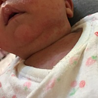 宝宝湿疹好严重 怎么办😭