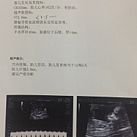 今天去做了NT，范围超了0.3。然后又去做无创，现在好担心，什么心情都没有了。现在等结果出来，希望宝宝...