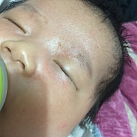 大家帮我看看这是什么 是湿疹吗？