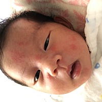 宝妈们看看宝宝过敏咋办？