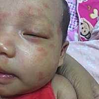哪位宝妈知道我家宝宝脸上起的是湿疹吗？出生时就有几块，以为是胎里热到了，一凉快就变淡，现在越来越...