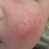 宝妈们，我宝宝脸上这个是湿疹吗？去医院复诊，医生说不用管的，会自己好～但是四五天了，看着好难受～