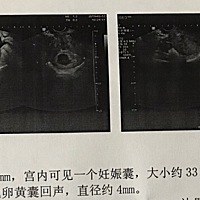 问问各位宝妈，怀孕约7周，孕囊大小约33×24mm，正常吗？