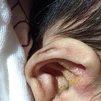 有宝宝耳朵里流出这些的吗？结痂了都，用水擦了有味道？求解宝妈们急切