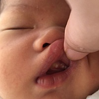 宝宝嘴里长的是什么呀？上火吗？