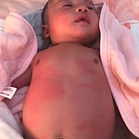 宝宝身上一块块红的，一会又消了，一会别的地方又有，像过敏一样，不知道是什么原因导致的，各位宝妈有...