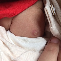 前两天宝宝打完预防针，今天刚想给她洗澡，发现手臂这样了，请问正常吗？可不可以洗澡呀？