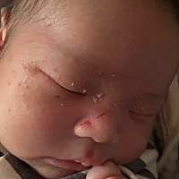 21天的宝宝脸这样需要去医院看看吗，鼻子是自己挠的