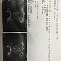 有哪位孕妈跟我一样情况的，医生说可能会导致先兆流产，该怎么办