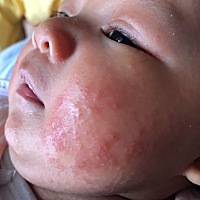 求助，各位妈妈，宝宝脸上长这个应该怎么办？