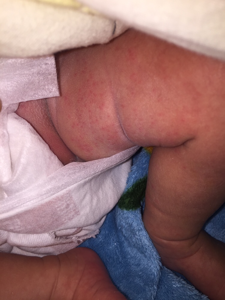 宝宝腿上和脖子上这个是什么？急急，在线等？