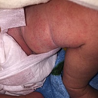 宝宝腿上和脖子上这个是什么？急急，在线等？