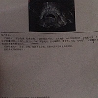 怀孕从月经来的那天有五十多天了，可是今天去检查还是没有胎心胎芽，之前四十天左右去检查医生说太小了...