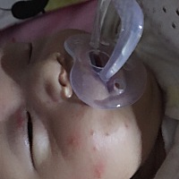 亲们 这是疱疹还是湿疹啊？