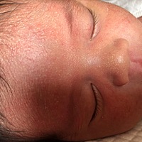 宝宝出生13天啦，从11天开始额头和脸上长了一些小脓包，额头上密集较多，头皮上也有一些，脸颊上少一点...