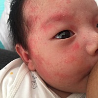 智齿发炎导致扁桃体也发炎，张不开合不上的，哺乳期宝宝23天，可以喝母乳么，而且宝宝最近脸上还有很多...