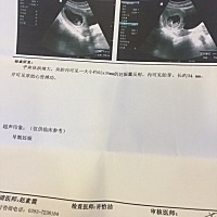 怀孕74天，第一胎，好奇宝宝的性别😀