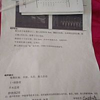 有没有脐绕颈的宝妈，这个不知道有没有事！求指教。