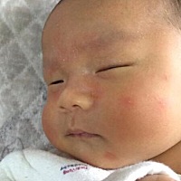 今天洗澡看到小孩脸上是湿疹还是什么请问有什么办法能解决。