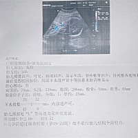 去做四维的时候说是羊水太少，第二天又去做了普通b超，医生说是正常，到底哪个可信度比较高，四个象限加...