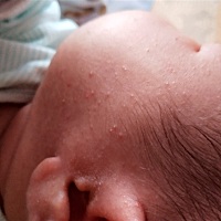 宝妈们，有没有对湿疹效果好一点东西，推荐一下，宝宝脸上湿疹严重。