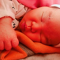 宝宝脱皮好心疼 你们的宝宝会脱皮吗