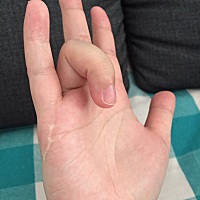 那些月子里玩儿手机的，你们现在怎么样了？给大家展示下我的新技能😂握拳之后，有一只手指头就展不开...