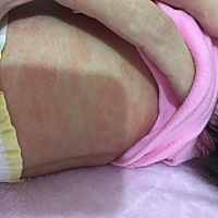 有经验的妈妈们：宝宝刚出生26天，请问宝宝身上一块块泛红是什么原因呢